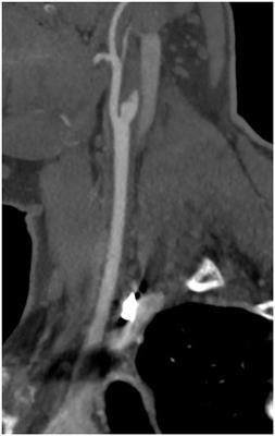 Case report: Cervical arterial dissections in the setting of recent COVID-19 infection